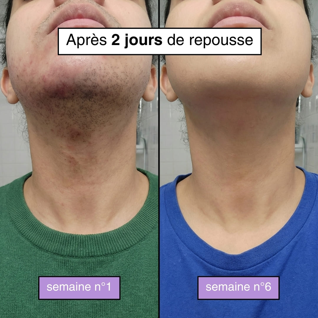 Sérum Anti-Repousse – Cyperus Rotundus